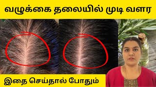 வழுக்கை தலையில் முடி வளர இதை செய்தால் போதும்  100 Effective  Baldness Remedy [upl. by Tito]