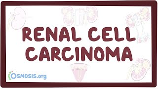 Renal cell carcinoma  an Osmosis Preview [upl. by Shay854]