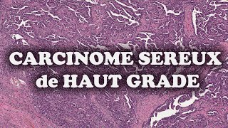 LE CARCINOME SEREUX DE HAUT GRADE DE L’OVAIRE  PATHOLOGIE [upl. by Yttocs]