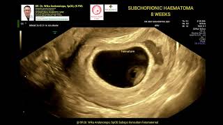 Subchorinic Haematoma 8 weeks [upl. by Gereron186]