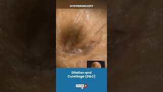 बच्चेदानी Uterus का Dilation और Curettage  Procedure for removing unwanted tissue in uterus [upl. by Travers]