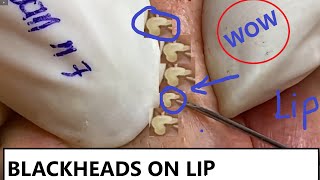 REMOVAL BLACKHEADS ON LIP AND FACE n7  LOAN NGUYEN [upl. by Adnoek]