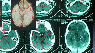 Introdução á neuroimagem de crânio Parte 2 [upl. by Kruse]
