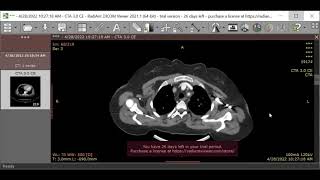 Takayasus arteritis [upl. by Ahmad]