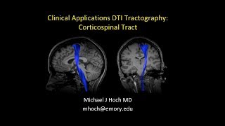 MRI Diffusion Tensor Imaging DTI interpretation  locating the corticospinal tract CST [upl. by Lambertson]