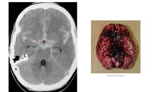 Subarachnoid haemorrhage [upl. by Eimiaj894]