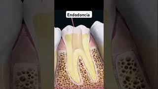 Endodoncia parati fyp endodoncia endo dolordemuela infecciondental viralfypシ [upl. by Arabrab]