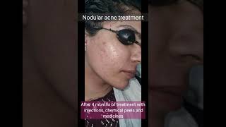 Nodular acne treatment  DrArif Iqbal  Before and After treatment [upl. by Pickford]