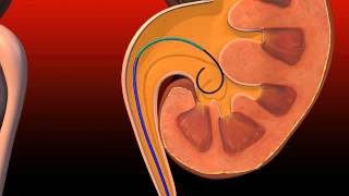 Ureteral Obstruction  Retrograde insertion of Resonance stent [upl. by Sansone198]