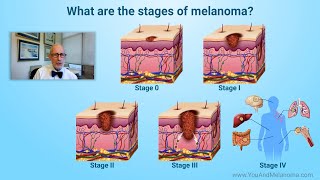 What are the stages of melanoma [upl. by Athelstan792]