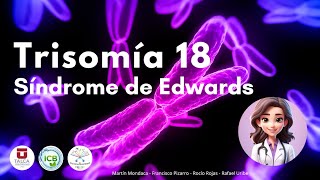 Trisomía 18 ‐ Síndrome de Edwards [upl. by Atteuqram]