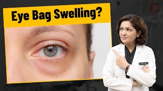 How to treat under eye swelling shorts youtubeshorts undereye swelling eyebags plasticsurgeon [upl. by Anyat]