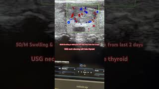 Thyroid nodule Thyroid Mass TIRAD4 video shorts reels neck pain thyroid ultraradiology [upl. by Spanjian526]