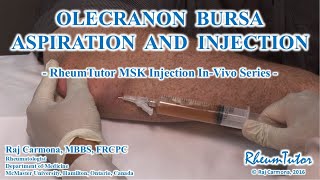 OLECRANON BURSA ASPIRATION  INJECTION  InVivo Series [upl. by Bonni]