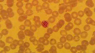 Plasmodium vivax schizont stage [upl. by Chucho]