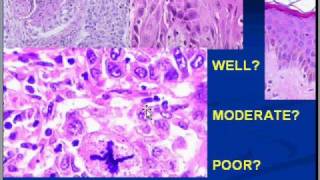 Medical School Pathology Chapter 7n [upl. by Karlens]