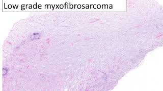 A guide to low grade myxoid sarcomas [upl. by Niarfe]