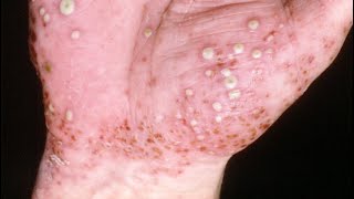 Pustular Psoriasis Diagnosing and Treating It [upl. by Iraam]