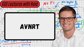 AV Nodal Reentry Tachycardia  Day 16 ECG Challenge [upl. by Wichman]