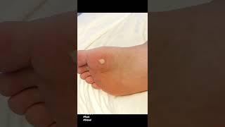 Foot Blisters 🦶🏼🩸😩 after 21k steps viral funnyvideos subscribe trending shorts blisters [upl. by Afrika]