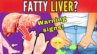 8 SIGNS THAT INDICATE LIVER FAT  EARLY SYMPTOMS OF HEPATIC STEATOSIS silent threat [upl. by Winthorpe]