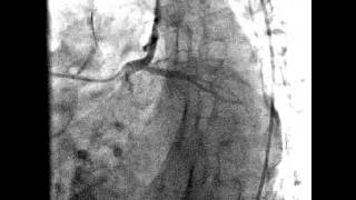 Angiografía coronaria  arterias cardiacas normales [upl. by Akcirret]