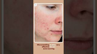 PostAccutane Treatments Reduce Acne Scars with Microneedling amp More [upl. by Nessie]