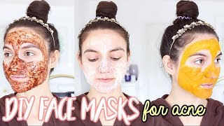 4 DIY Face Masks For ACNE  How To Get Rid Of Pimples OVERNIGHT [upl. by Anifad]