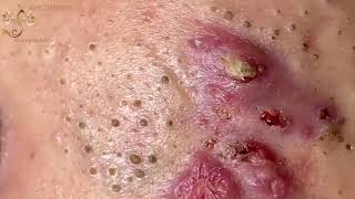 Blackheads Extraction Whiteheads Removal Pimple Popping 1 [upl. by Isadora]