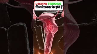 जाने कौन सा फाइब्रॉएड है ज्यादा खतरनाक  Different types of fibroids  रसोली की समस्या [upl. by Soisanahta968]