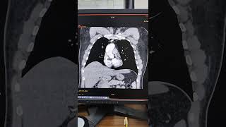 CT Chest with Contrast What to Expect anatomy cardiacimaging brainhealth [upl. by Rehpotisrhc592]