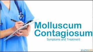 Molluscum Contagiosum ¦ Treatment and Symptoms [upl. by Miriam]