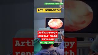 ACL AVULSION FIXATION SURGERY IN JAIPUR [upl. by Orips]