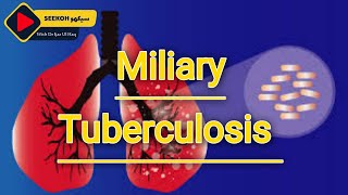 Miliary tuberculosis  Miliary Tb Couses  Sign Symptoms and treatment in Hindi  Urdu By Dr ijaz [upl. by Lekram]