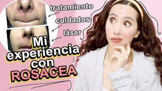 Mi Experiencia con ROSACÉA Diagnóstico tratamiento láser y rutina de skin care [upl. by Anirdnajela]