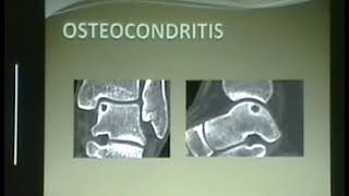 85Cuál es el cuadro clínico de la osteocondritis del tobillo [upl. by Enetsuj]