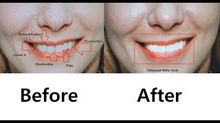 Veneer Design Simulation in Korea Smile Makeover Realtime Design  Seoul Guide Medical [upl. by Tse]