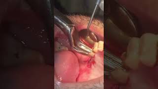 Extraction of upper right second molar roots [upl. by Christen]