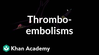 Thromboemboli and thromboembolisms  Miscellaneous  Heatlh amp Medicine  Khan Academy [upl. by Haynor]