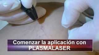 Telangiectasias con Plasmalaser SCORPION [upl. by Nagey]