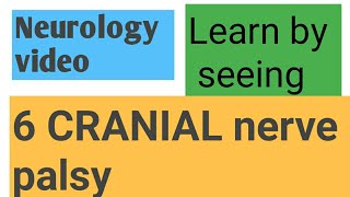 Rt abducens palsy  rt 6 cranial nerve palsy [upl. by Arturo]