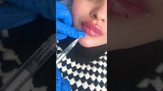 Russian Lip Filler Tenting Technique  Dermalyn Aesthetics  Permanent Makeup Clinic [upl. by Etsirhc860]