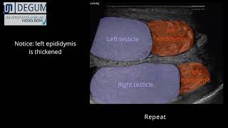 Episode 42 Epididymitis [upl. by Agamemnon]