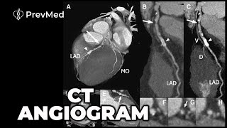 CT Angiogram  Its Better Than Stress Tests [upl. by Florenza]