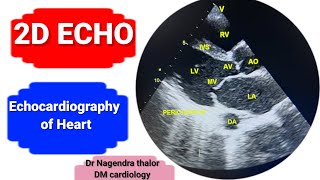 2D Echocardiography of heart Echo test in hindiHeart pumping valvesHole by ECHO [upl. by Cruz]