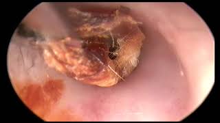 Gros bouchon de cérumen earwax removal Dr JB Danvin [upl. by Eittak465]