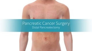 Distal Pancreatectomy How the Procedure Is Performed [upl. by Aivilys]