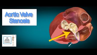 Aortic Valve Stenosis I Human Anatomy Tutorial [upl. by Ennaylloh]