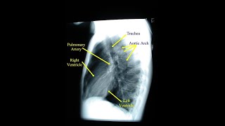 Lateral View of A Chest Xray  Definition structures and Uses [upl. by Zilef122]