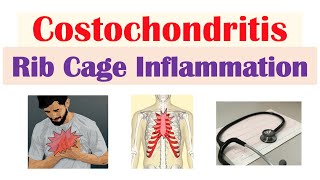 Costochondritis Rib Cage Inflammation  Causes Symptoms Diagnosis Treatment [upl. by Soracco914]